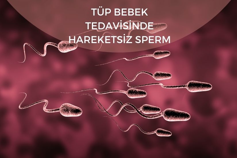 Tüp bebek tedavisinde hareketsiz sperm kullanılır mı